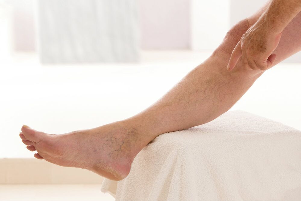 vene varicose sulle gambe